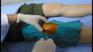 Knee aspiration technique Knee synovitis เจาะเข่า เข่าอักเสบ [upl. by Nishi]