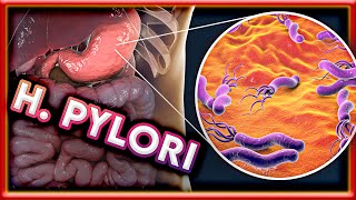 Is H Pylori causing your GUT ISSUES How to cure Helicobacter Pylori [upl. by Yusuk108]