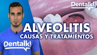 ¿Alveolitis seca solo en la muela del juicio [upl. by Asim]