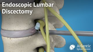 Endoscopic Lumbar Discectomy [upl. by Sivle]