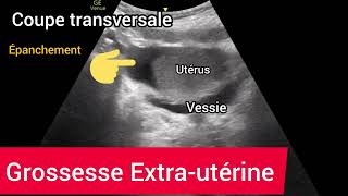 Grossesse Extrautérine Hématosalpynx Hémopéritoine Échographie Ectopic Pregnancy Ultrasound [upl. by Maressa]