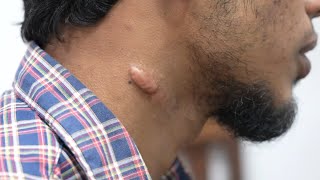 Keloid Scar on Neck Removal Consultation  Dr Sunil Richardson [upl. by Andres]