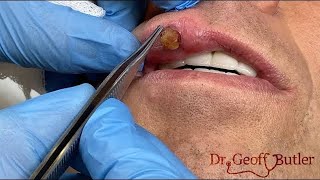 Removal of a pyogenic granuloma on the lip [upl. by Assiralk162]