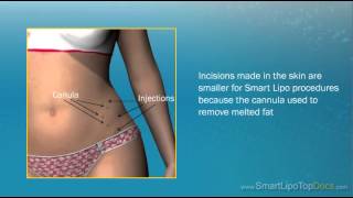 Recovery Tips  Smart Lipo [upl. by Nosoj898]