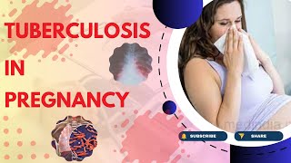 Tuberculosis in Pregnancy Causes Symptoms Diagnosis Treatment and Pathology  TOG Article [upl. by Fosdick]