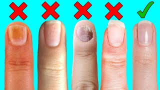 8 Things Your Nails Can Say About Your Health [upl. by Ariaet912]