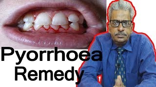 Pyorrhea  Discussion and Treatment in Homeopathy by Dr PS Tiwari [upl. by Beatrix416]