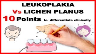 leukoplakia vs lichen planus  10 points to differentiate clinically [upl. by Nnep]