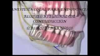 Bloqueo regional en endodoncia de conducción o bloqueo nervioso [upl. by Denys817]