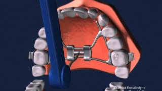 Advanced Orthodontics  Expanders [upl. by Whale]