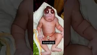 Anencephaly youtubeshorts viral newborn paediatrics birth medical trending doctor obgyn kb [upl. by Abagael]