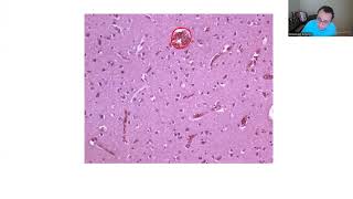 NEUROPATHOLOGY BOARD REVIEW 1 [upl. by Zaslow603]