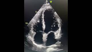 echocardiography echocardiographer heartcondition SafaMedicalLecture [upl. by Abad342]