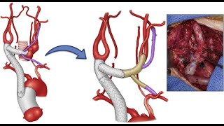 What Is Takayasu Arteritis  Symptoms Complications amp Treatment Methods [upl. by Sadnac]