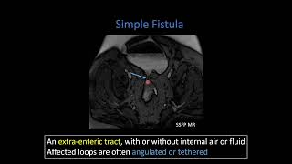 Crohn Disease Part 2 Penetrating Disease and Mesenteric Inflammation [upl. by Aciraa]