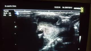 Branchial Cleft Cyst Ultrasound [upl. by Dagley]