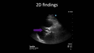 PointofCare Echo Aortic Stenosis vs Sclerosis [upl. by Esyahc685]