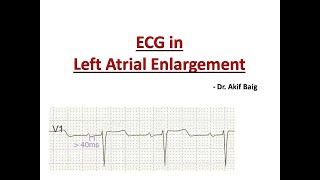 ECG in Left Atrial Enlargement  Dr Akif Baig [upl. by Yi817]