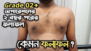 ২ বছর পর Gynecomastia surgery রোগী কেন আসলেন [upl. by Attelrahs]