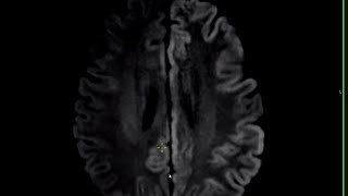 neuroradiology masterclass P4 [upl. by Epps362]