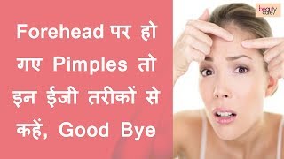 Get Rid of Forehead Pimples with these Easy Ways Hindi [upl. by Sami907]