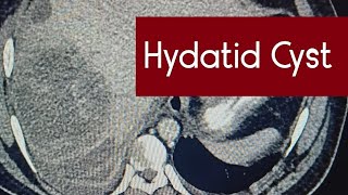 Hydatid cyst Hepatic cect ctscan interesting case presentation radiology doctor radio [upl. by Efinnej118]