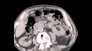 CT Abdomen Pelvis Renal Cysts Seminal Vesicle hemorrhage Discussion by Radiologist [upl. by Eirolam]