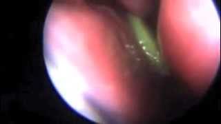 Foriegn Bodies Nose Endoscopic removal [upl. by Carolee]