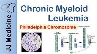 Chronic Myeloid Leukemia CML  Pathogenesis Symptoms and Treatment [upl. by Rosemarie772]