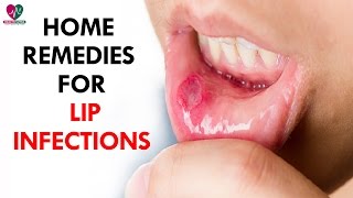 Home Remedies For Of Lip Infections  Health Sutra [upl. by Onil]