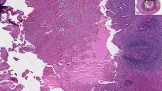 Histopathology Acute Appendicitis [upl. by Ettenim600]