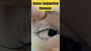 Severe Conjunctival Chemosis  conjuctivitis Treatment below 👇optometry [upl. by Bega]