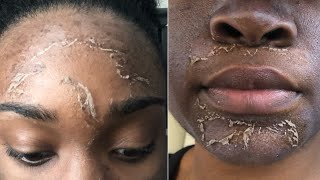 I GOT A CHEMICAL PEEL FOR HYPERPIGMENTATION  BEFORE amp AFTER RESULTS [upl. by Gnouh]