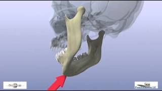 fractures of the mandibular condyle [upl. by Lleumas]