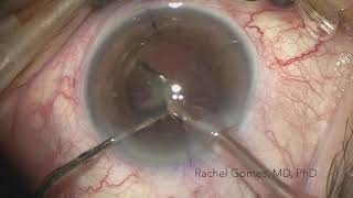 FINEVISION TORIC implantation by Dra Rachel Gomes [upl. by Llirret458]