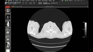 STR Cardiothoracic Case Webinar 192020 [upl. by Teryl]