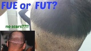 FUE vs FUT Which Hair Transplant Method is Better [upl. by Llehsal]