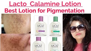 Best Lotions Lacto Calamine for pigmentation pimples 21 days pigmentation Challenge simple diets fa [upl. by Aninat]