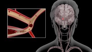 Carotid Dissection [upl. by Aubrette]