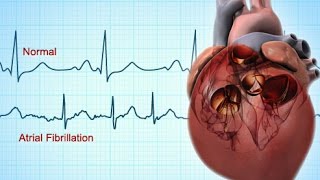 MM  Medical Cardioversion of Atrial Fibrillation in the ER [upl. by Eanar181]