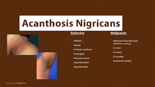 Acanthosis Nigricans  What is Acanthosis Nigricans amp What are its CAUSES [upl. by Estas]