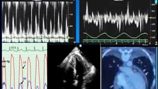 Constrictive pericarditis diagnosis echocardiography and treatment [upl. by Laehcym455]