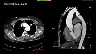 Imaging in Phakomatosis [upl. by Reina]