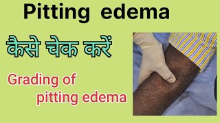 Pitting edema How to examine pitting edema Grades in pitting edema [upl. by Barina876]