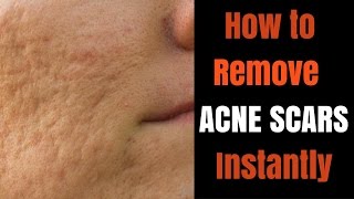 Instant acne scar removal [upl. by Yngiram322]