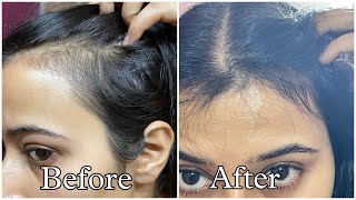 Best Hair Serums For Reduced Hair fall and Hair Growth [upl. by Erdah]