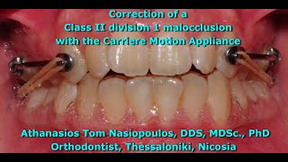 Class II Correction with the Carriere  Athanasios Tom Nasiopoulos [upl. by Alyag]