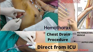 Chest Drain Procedure Direct From ICULive Demonstration and Details Procedure [upl. by Euqinemod607]