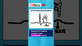 Electrolytes ECG Changes medical doctor nursing [upl. by Oijimer]