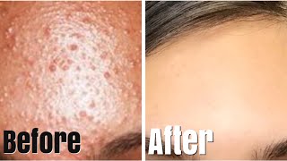 HOW TO REALLY GET RID OF SMALL FOREHEAD PIMPLES [upl. by Ytsud]